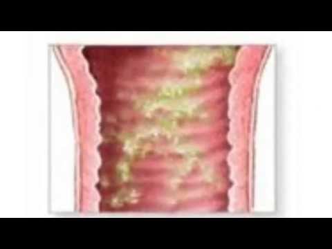 Gewichtheben und Prostatitis Heimtrainer Vorteile der Prostata