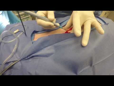 Bovie® Animal Health -  Initial Opening with Bovie Electrosurgery