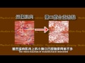不打網球竟有網球肘？復健師解疑惑