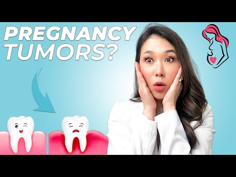 Pregnancy Gingivitis
