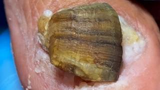 Onychomycosis Protrudes Like A House, With Mold Inside【Xue Yidao】