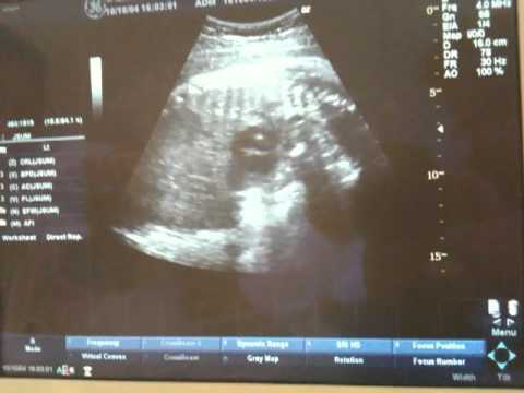 Caçulinha 40 Semanas