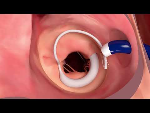 Edwards Lifesciences SAPIEN M3 transcatheter mitral valve replacement system - Procedural Animation