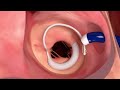 Edwards Lifesciences SAPIEN M3 Transcatheter Mitral Valve Replacement System Procedural Animation