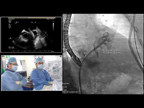 [AP VALVES & SH 2019] Live Case & Lecture 6: LAAO #9
