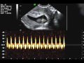 8 weeks 2 days Ultrasound Heartbeat