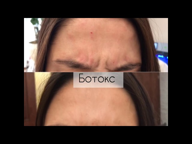 Коррекция морщин ботоксом