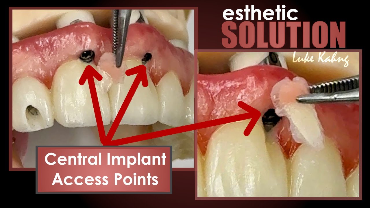 Highly Esthetic Solutions for Difficult Case with Front, Central Implant Access Points