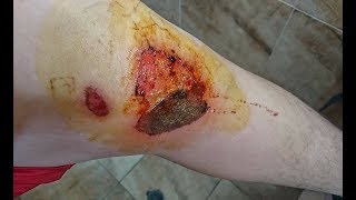 Abrasión por asfalto