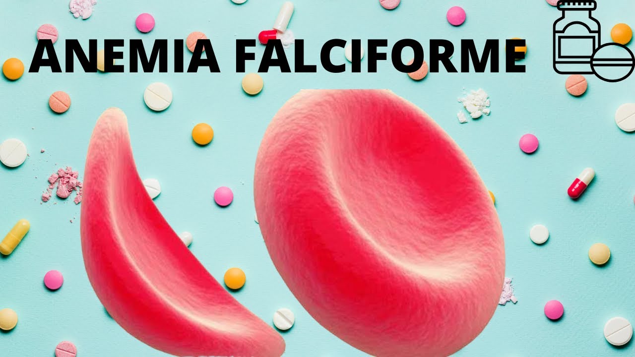Anemia Falciforme