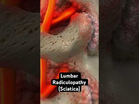 Sciatica Explained (3D Animation)