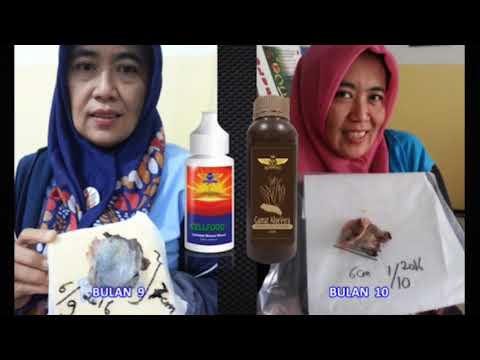 Pengalaman Pendukung Pemulihan Pasien Mioma & Kista