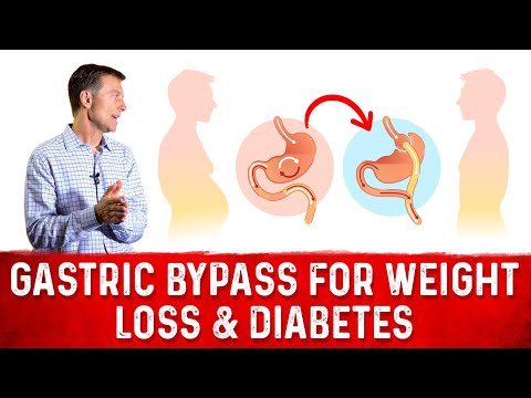 Can Diabetes Be Reversed – Dr Berg