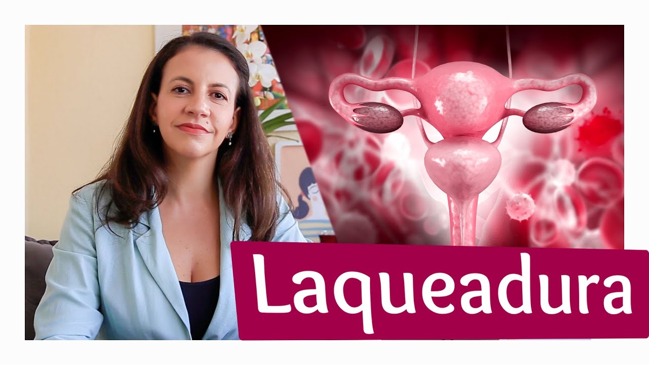 O que é laqueadura ??