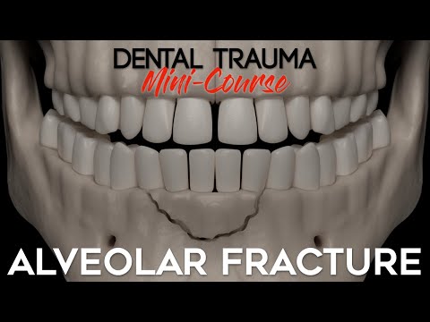 Dental Trauma Mini-Course - Part 11 - Dental Trauma Guide - Alveolar Fracture