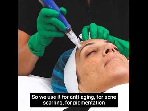 Microneedling with SkinPen | Nancy Rozs | Medical Aesthetician at Rendon Center