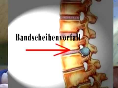 Beste Salbe für Verstauchungen der Gelenke Linker Knieprothese