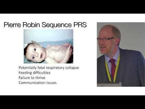 Cleft Palate 2: Paul Morris – Symptoms, Signs and Syndromes