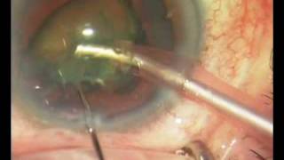 Cirugia de Cataratas | Lente Mplus | Clinica Cirugia Ocular - Clínica Rementería