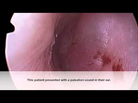 Middle Ear Paraganglioma (Glomus Tumor) Endoscopy