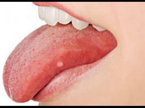 a papilloma megszünteti az onkológust mit írnak fel a nemi szemölcsök kezelésére