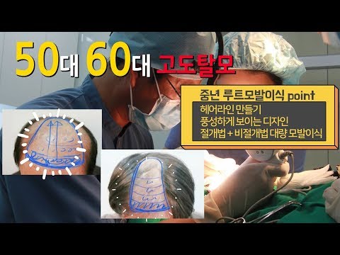 100세시대 50대 60대 모발이식 고도탈모 대량탈모  루트가 해결해 드립니다.