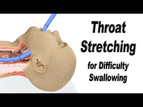 Esophageal Dilation or Throat Stretching for Difficulty Swallowing