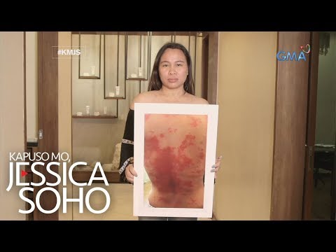 Kaysa sa paggamot ng kuko halamang-singaw kamay Paggamot ng kuko grooves