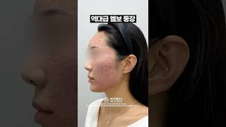역대급 리쥬란 엠보