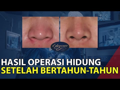 Sendi di frenulum plastik penis Varises di testis dan potensi
