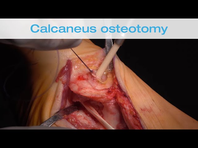 Video Uitspraak van calcaneus in Engels