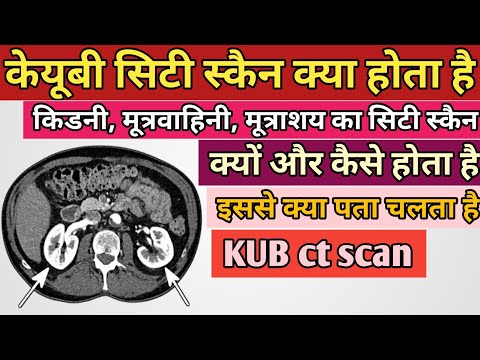 केयूबी सिटी स्कैन क्यों और कैसे होता है || KUB ct scan in Hindi || Ct scan kub kaise hota hai