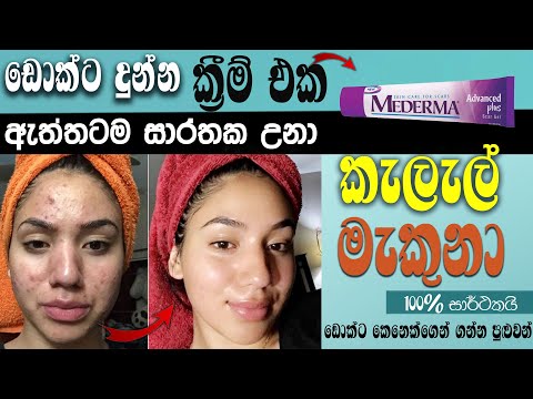 කුරුලෑ වලවල් දින 3 න් නැති කරන බෙහෙත් | lapa kalal walata beheth | lapa kalal walata cream