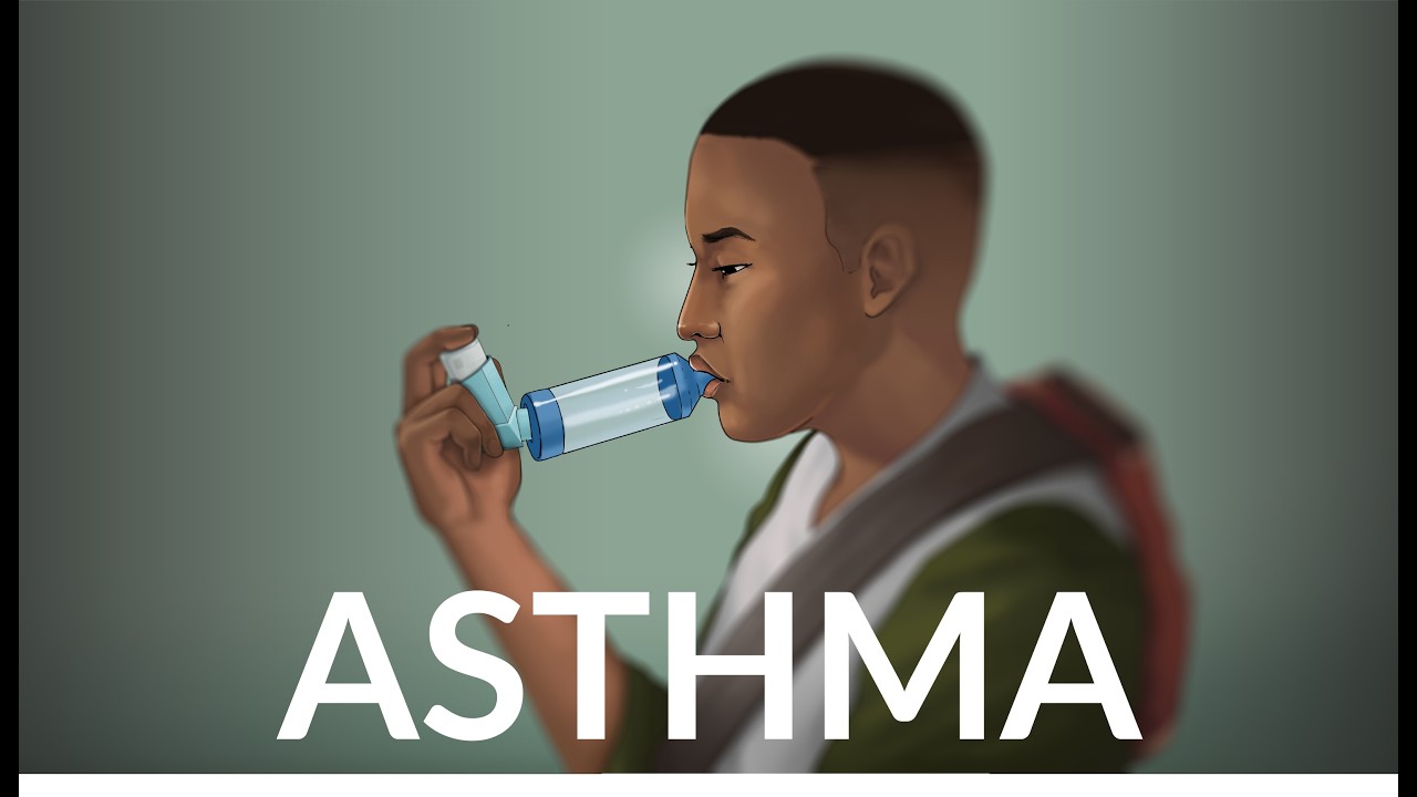 Asthma by J. Pian, L. Chiel, L. Rubin, A. Erickson | OPENPediatrics
