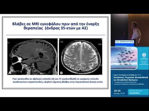 Καλτσονούδης Ε. - Νευρολογικές εκδηλώσεις των αντι-TNFα παραγόντων
