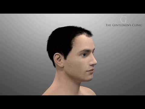 So funktioniert eine Haartransplantation