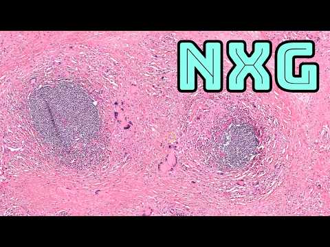 NXG Necrobiotic Xanthogranuloma (associations IgG kappa MGUS monoclonal gammopathy multiple myeloma)