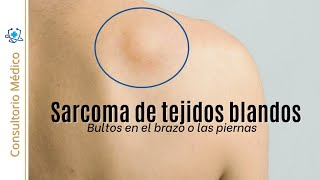 Sarcoma de Tejidos Blandos | Bultos en el brazo o las piernas 👨‍⚕️ Consultorio Médico