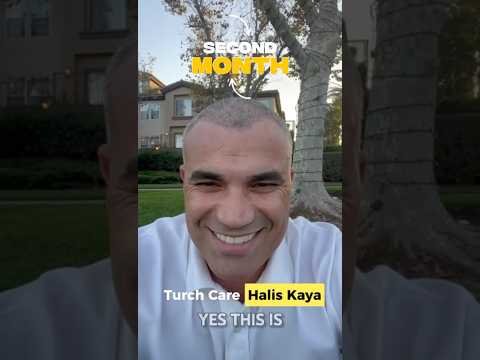 Here’s my Month 2 hair transplant update! #turchcare #hairtransplant #hairrestoration