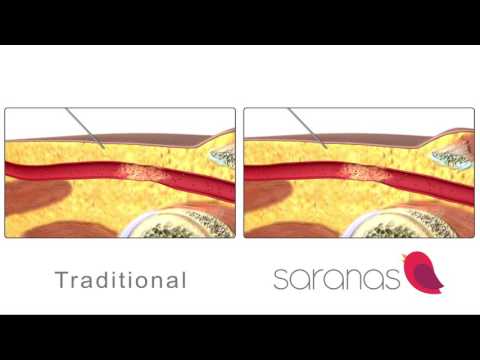 Saranas Vascular Access Procedure Clip & Comparison