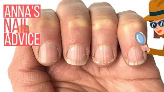 RIDGY NAILS? THE COSMETIC SOLUTION. [ANNA