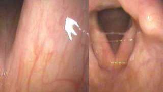 Reflux Laryngitis