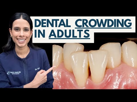 Dentist Explains How To Fix Crowded Teeth! What Is Dental Crowding in Adults