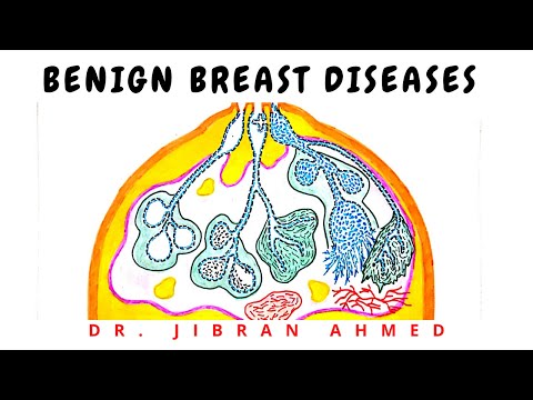 BENIGN BREAST DISEASE