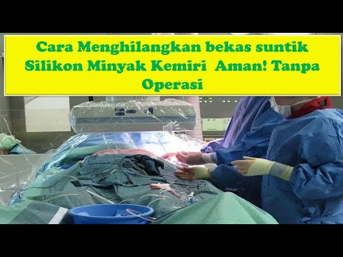 Cara Menghilangkan bekas suntik Silikon Minyak Kemiri  Aman! Tanpa Operasi