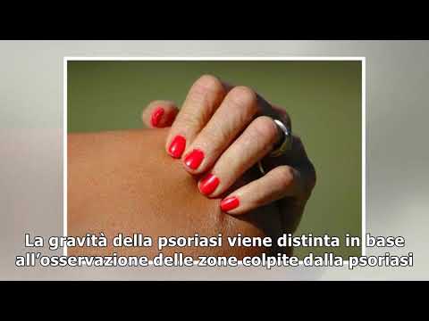 Quello che gli unguenti usano a eczemi su mani Come curano la dermatite atopic in un ospedale