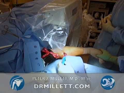 Distal Biceps Rupture | Biceps Tendon Surgery | Vail, Colorado