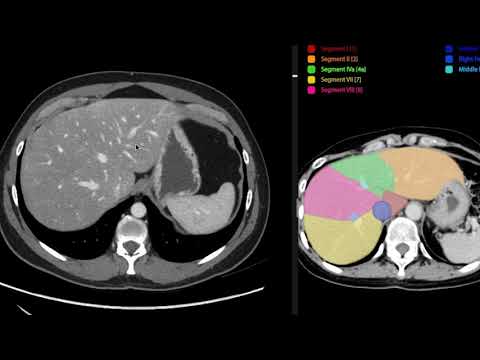 Anatomia de abdomen y pelvis por tomografia computada
