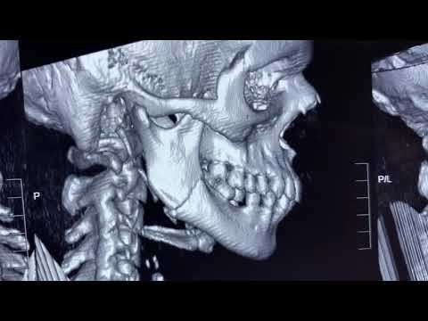 Mandibular Angle Fracture: Intra-Oral Rigid Fixation With Titanium Implants
