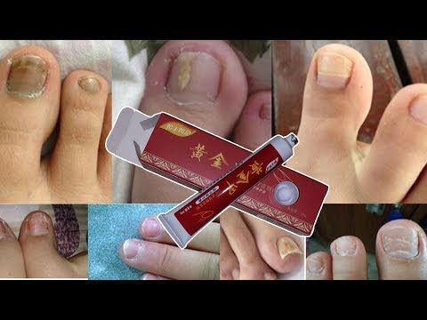 Candida fungus sa kuko Powder ng halamang-singaw sa kanyang mga paa